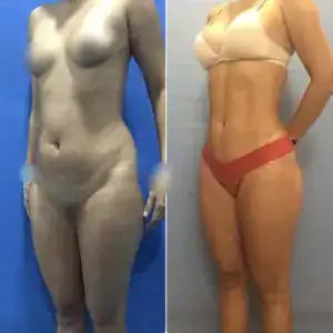Reducción de grasa corporal antes y después de cirugía estética en Bogotá.